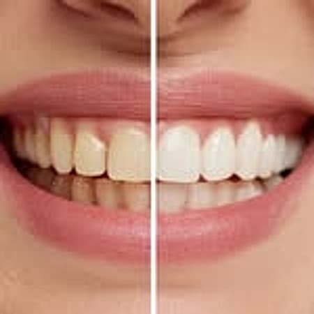 Resultado real de clareamento dental, antes e depois